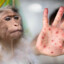 Monkeypox