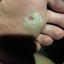 Blister on foot