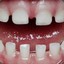 Chiclet Teeth