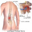 HERNIA
