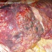 Цирроз Печени