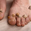 foot fungus