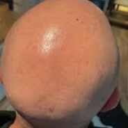 Bughar's Bald Head