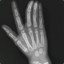 syndactyly-