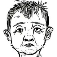 syndrome de l'oncle