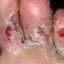Foot Fungus