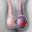 Testicular  Torsion