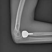 functional elbows = 0