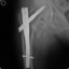 Acetabulum