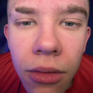 Chore_Łyse_Jaja_Małego_Michał