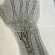 Rip Wrist
