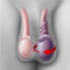 testicular_torsion