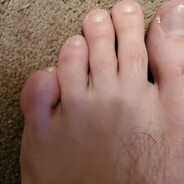 toe stubber