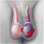 Testicular torsion