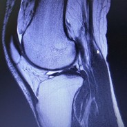 damaged meniscus