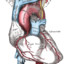 Naortic_dissection