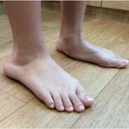 Плоскостопие