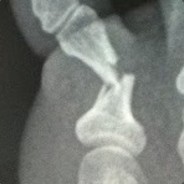 Stubby McStub-Toe