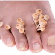 Foot Fungus