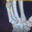 broken right hand