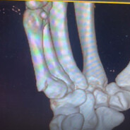 broken right hand