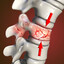 VertebraFracturada