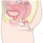 Analgeton