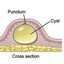 CystOnMyTip