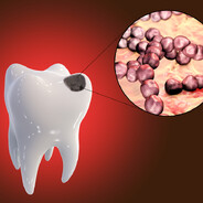 Streptococcus_mutans