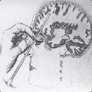 Lobotomy