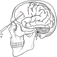 lobotomy