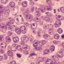 Diffuse Large B-Cell Lymphoma
