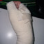 broken thumb