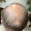 BaldSpot