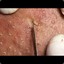 Blackhead Acne