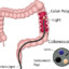 UnderperformedColonoscopy96