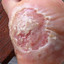 Fat Wart