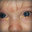 Conjunctivitis