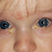 Conjunctivitis