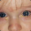 Conjunctivitis