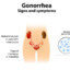 Gonorrhea Signs and Symptoms