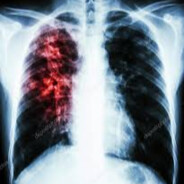 Tuberculosis