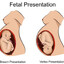 Breech presentation