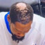 KD&#039;s bald spot