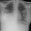 Community Acquired Pneumonia, HR