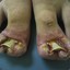 infected toes