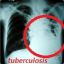 tuberculosis