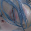 anxiety disorder