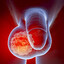 Câncer Testicular