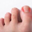 Ingrown Toenails